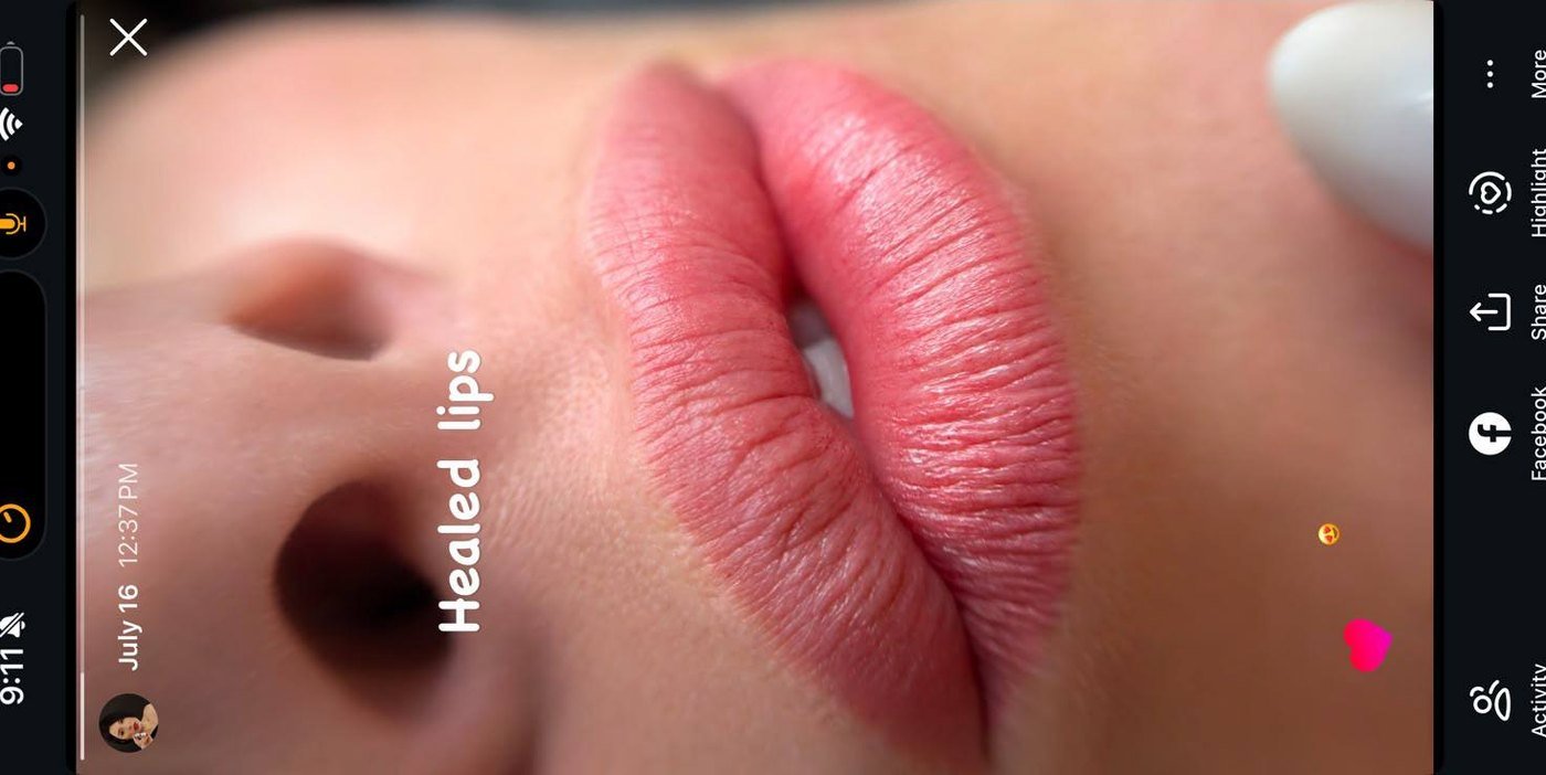 Healed Lips